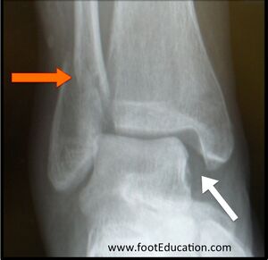 Figure 6: Oblique Fracture of the Fibula (red arrow) Produced by Twisting.