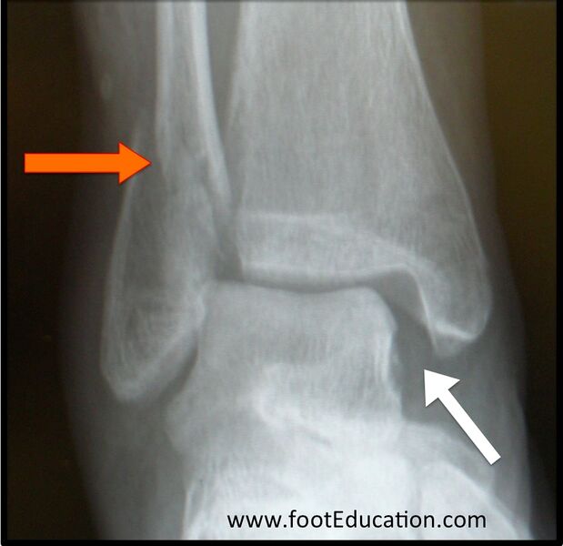File:Distal fibula oblique fracture.jpg