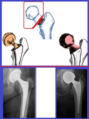 Femoral neck fracture joint replacements.jpg