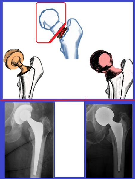 File:Femoral neck fracture joint replacements.jpg