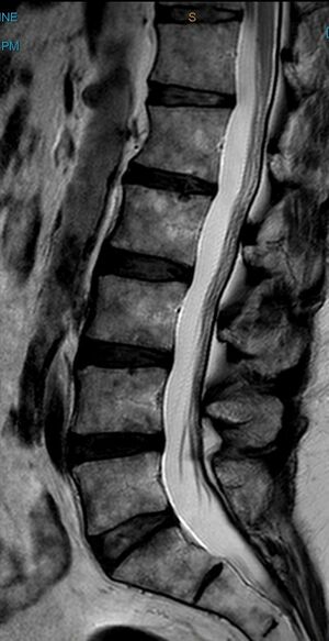Leg pain case 001 MRI Lumbar Spine Sagittal Median.jpg