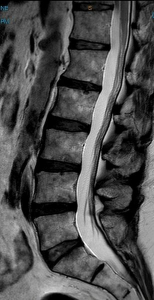 File:Leg pain case 001 MRI Lumbar Spine Sagittal Median.jpg