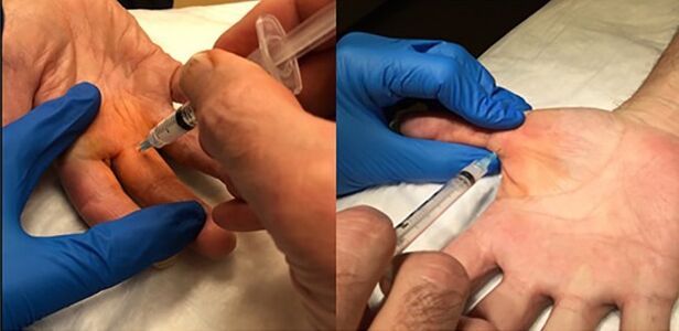 Proximal phalangeal intra-sheath injection technique.