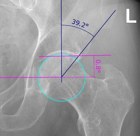 Figure 1. The lateral centre-edge angle (LCEA) and acetabular index (AI) on AP pelvic radiograph are measures of coverage of the femoral head by the acetabulum.