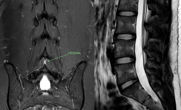 Another case MRI T2 coronal SPAIR showing interspinous oedema at the L4/5 interspace. It is not well seen on the sagittal.