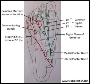 Mortons neuroma plantar nerves.jpg