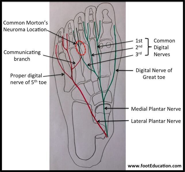 File:Mortons neuroma plantar nerves.jpg