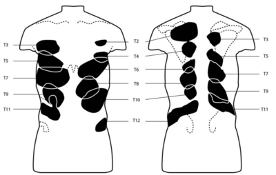 Referred pain patterns from noxious stimulation of the thoracic interspinous ligaments. Kellgren (1939).