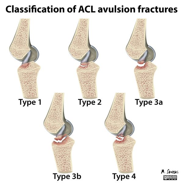 File:Diagram-classification-of-acl-avulsion-fractures-1.jpg