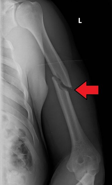 File:Humerus oblique fracture.jpg