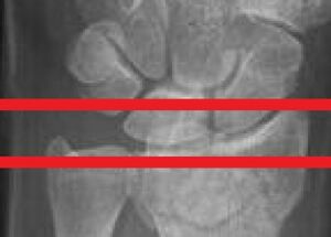 Figure 2: Assessment of radial height (In this x-ray, the articular surfaces of the distal ulna and radius lie on the same line, so-called "neutral" ulnar variance. When ulna projects more distally to the radius, ulnar variance is said to be "positive".)