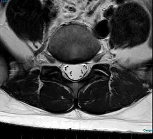 MRI T2 Lumbar Spine L5-S1 Transarticular Axial.jpg