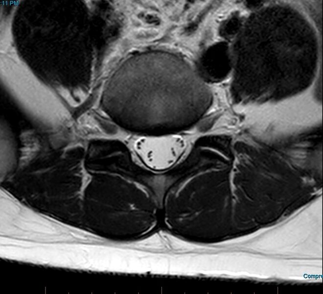 File:MRI T2 Lumbar Spine L5-S1 Transarticular Axial.jpg