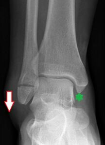 Figure 5: A Transverse Fracture of the Distal Fibula. This fracture is produced by a traction force, depicted by the arrow. The motion of the foot needed to produce this force may cause the talus to hit the tibia medially, producing a bone bruise if the force is mild (as shown by the star) or even a fracture on this side as well (not shown).