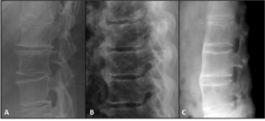 Spondylosis DISH and AS lumbar lateral.png
