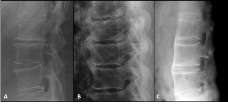 File:Spondylosis DISH and AS lumbar lateral.png