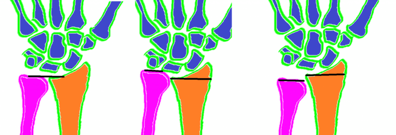 File:Ulnar variance schematic.png