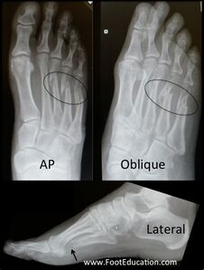 Figure 3: Metatarsal Fractures seen on X-Rays (AP, Oblique, and Lateral) of the Foot