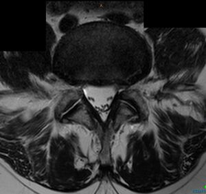 Leg pain case 001 MRI Lumbar L4-5 Transarticular.jpg