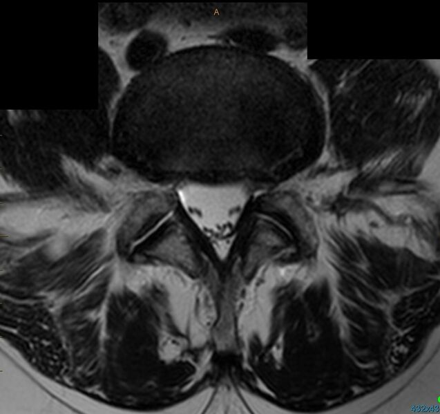 File:Leg pain case 001 MRI Lumbar L4-5 Transarticular.jpg
