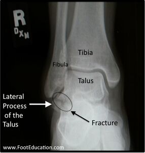 Figure 7: Talar Lateral Process Fracture