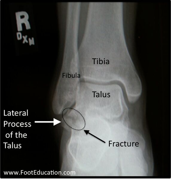 File:Talar lateral process fracture.jpg