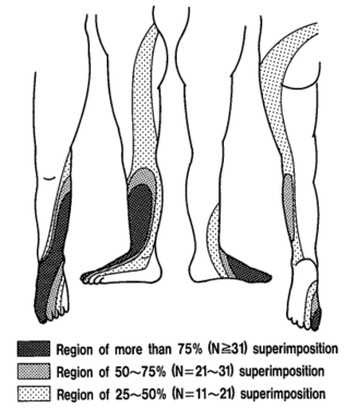 L5 block pattern: Extending from the midline of the trunk posteriorly, across the buttock, through the posterior, lateral aspect of the thigh and leg, to the 5th digit of the foot.