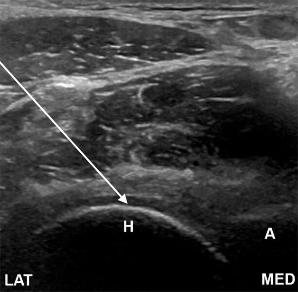 File:Hip joint injection anterolateral approach ultrasound.jpg