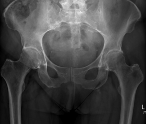 Hip x-ray frontal early osteoarthritis.png