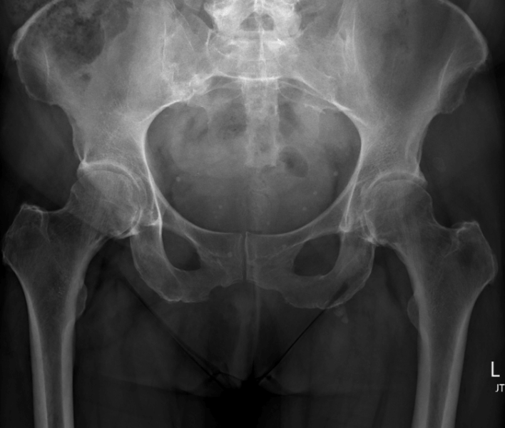 File:Hip x-ray frontal early osteoarthritis.png