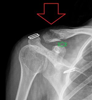 Distal clavicle fracture.jpg