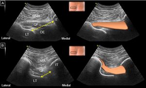 Quadratus femoris ultrasound.jpg