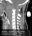 Atlanto-occipital dislocation