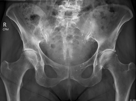 Moderate hip osteoarthritis. Cartilage space loss, subchondral sclerosis, and cystic change. Plus OA of inferior SIJs.