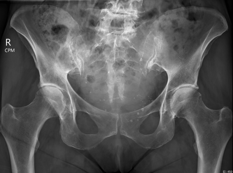 File:Hip x-ray frontal moderate osteoarthritis.png