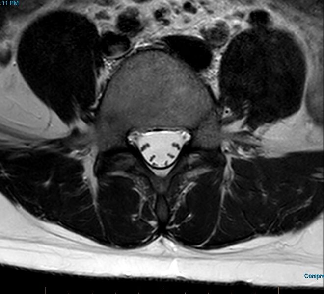 File:MRI T2 Lumbar Spine L5 Transpedicular Axial.jpg