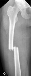 Figure 2: Fracture of the femur. As shown, the fracture is displaced and shortened. (Image courtesy of Kim, et al, https://doi.org/10.12671/jkfs.2015.28.1.71)
