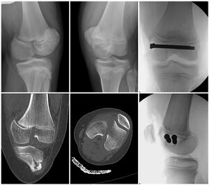 Figure 6: Salter-Harris III fracture of the distal femoral physis showing the fracture line splitting the epiphysis and continuing to the knee joint. Treated with open reduction to ensure restoration of the articular surface and held with cannulated screws.