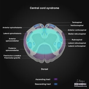 Incomplete-spinal-cord-syndromes-illustrations central.jpg