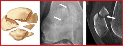 Figure 4: A schematic drawing, plain radiographs and a CT scan showing a comminuted patellar fracture. (Courtesy of Imaging of Patellar Fractures https://www.ncbi.nlm.nih.gov/pmc/articles/PMC5265199/)