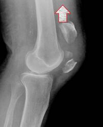 Figure 5: A displaced patellar fracture, in which the quadriceps pulls the proximal fragment more proximally (arrow). (From https://radiopaedia.org/articles/patellar-fracture-2)