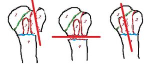 Figure 3: Various “two-part” fractures.
