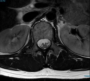 MRI T2 Lumbar Spine L1 Transpedicular Axial.jpg