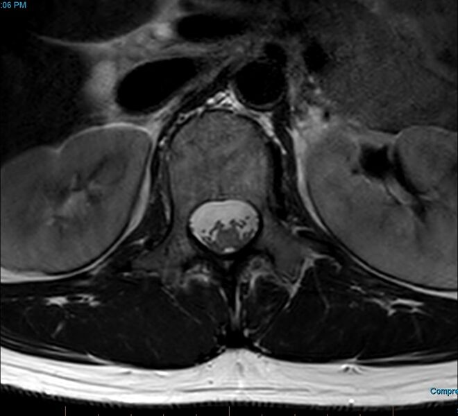 File:MRI T2 Lumbar Spine L1 Transpedicular Axial.jpg