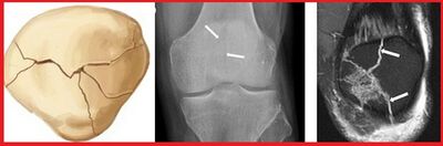 Figure 3: A schematic drawing, plain radiographs and an MRI image showing a stellate patellar fracture. (Courtesy of Imaging of Patellar Fractures https://www.ncbi.nlm.nih.gov/pmc/articles/PMC5265199/