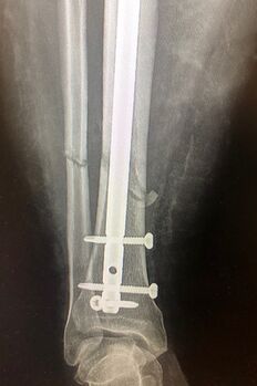 Figure 8: A locked intramedullary nail holds a tibia fracture in anatomic alignment. Note that the fibula is not fixed, but rather is stabilized indirectly by the tibia. (image courtesy of Dr. Jaimo Ahn)