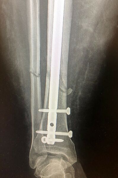 File:Tibia fracture intramedullary nail.jpg