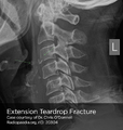 Extension-teardrop fracture