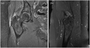 Gluteus medius MRI high grade partial thickness tear.jpg
