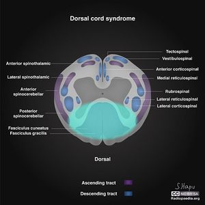 Incomplete-spinal-cord-syndromes-illustrations dorsal.jpg